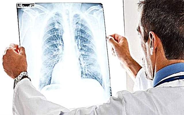 Keuhkosyöpä: hoito Saksassa
